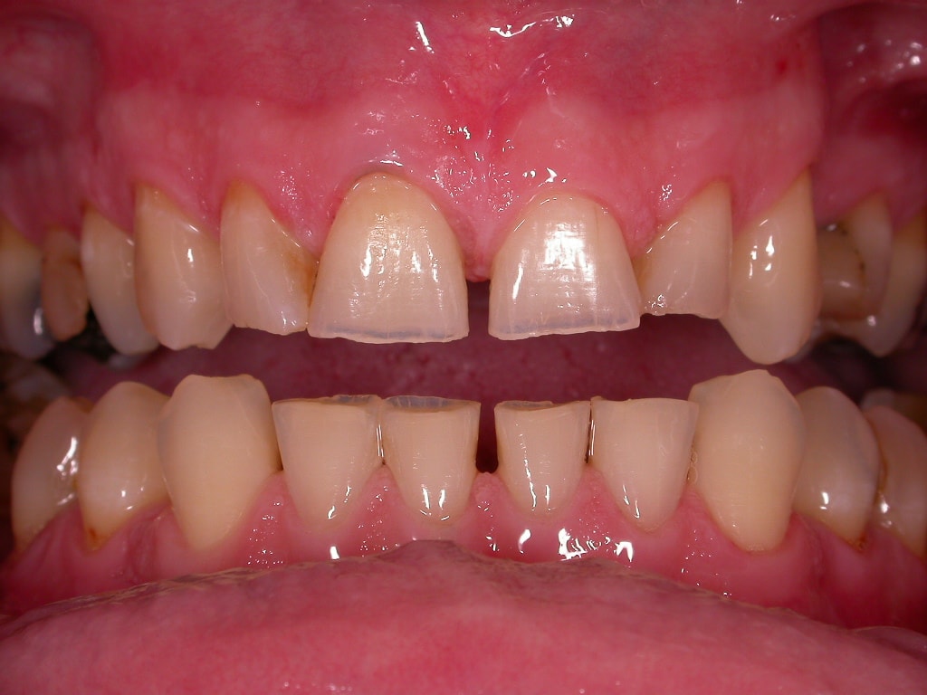 Angstpatient mit vielen Schäden und abgeknirschten Zähnen